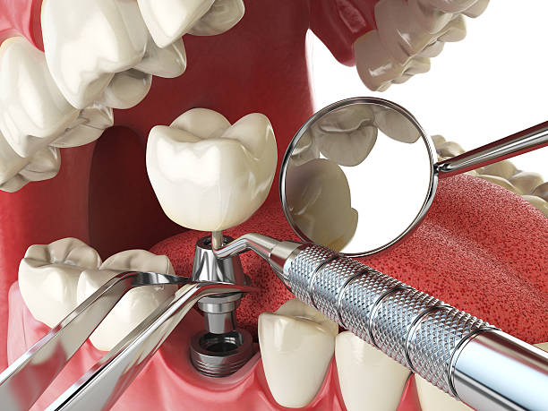 Best Emergency Root Canal Treatment in Edgewater, CO